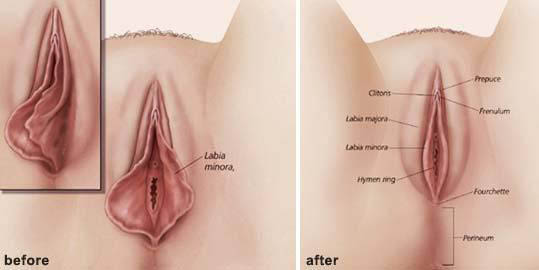 chirurgia intima femminile